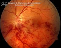 Inferior Hemicentral Retinal Vein Occlusion